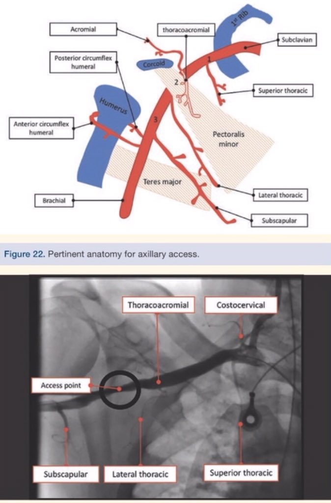 chadialraies's tweet image. #PercAx angiographic landmarks by @DrAmirKaki - #ACC18 #SCAI2018 #ACCIC #ACCFIT #ACCEarlyCareer #AHAFITEC #PAD - @DrSheilaSahni @Babar_Basir @CardiacConsult @drdevireddy @Almanfi_Cardio @DrSethdb