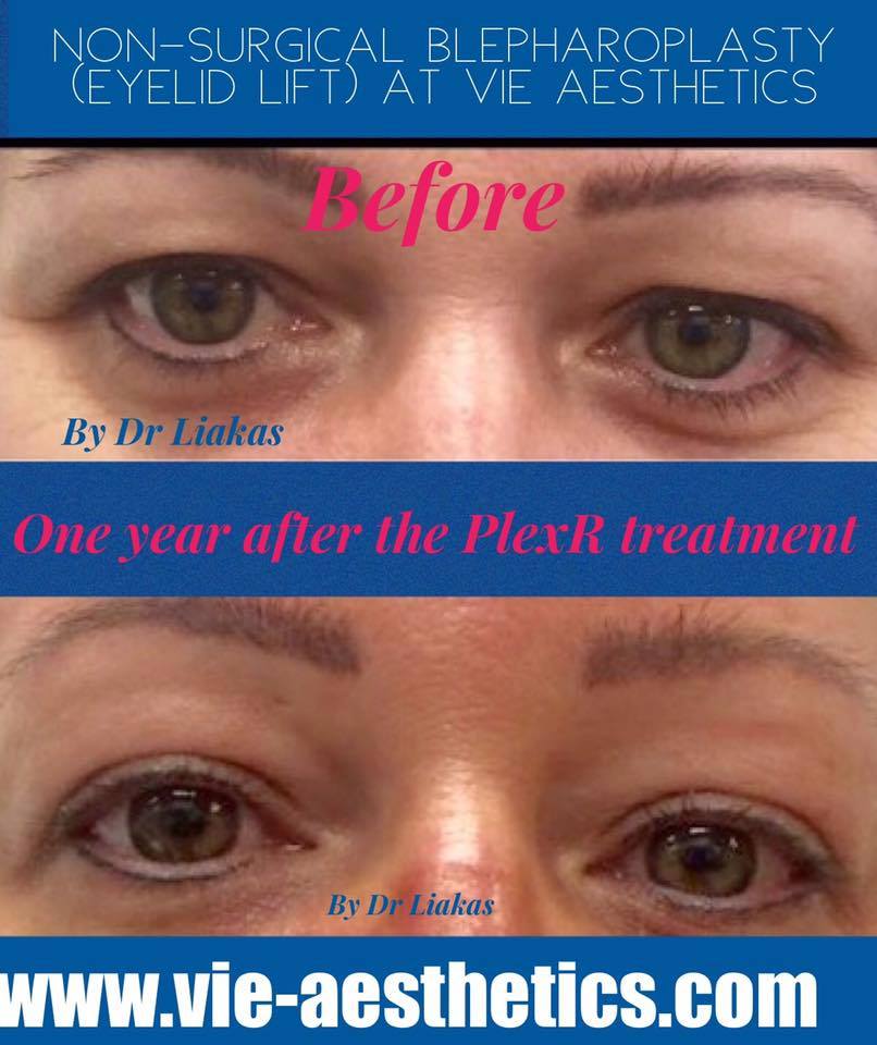 JustJennyEssex's tweet photo. #NonSurgicalEyeLift using #PlexR with #DrLiakas of #VieAesthetics @vieaesthetics for #DisneyEyes #JustJennyFromTheBlog #NonSurgicalSolutions #confidence https://t.co/Pj5Mo3c1sz