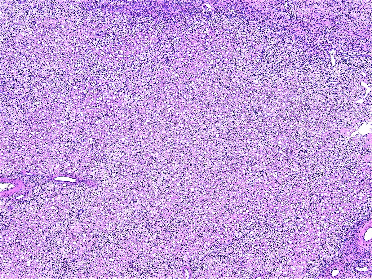 Patholwalker's tweet photo. Signet-ring stromal tumor. Ovary, enucleation. HE stain. https://t.co/O766UidnT1