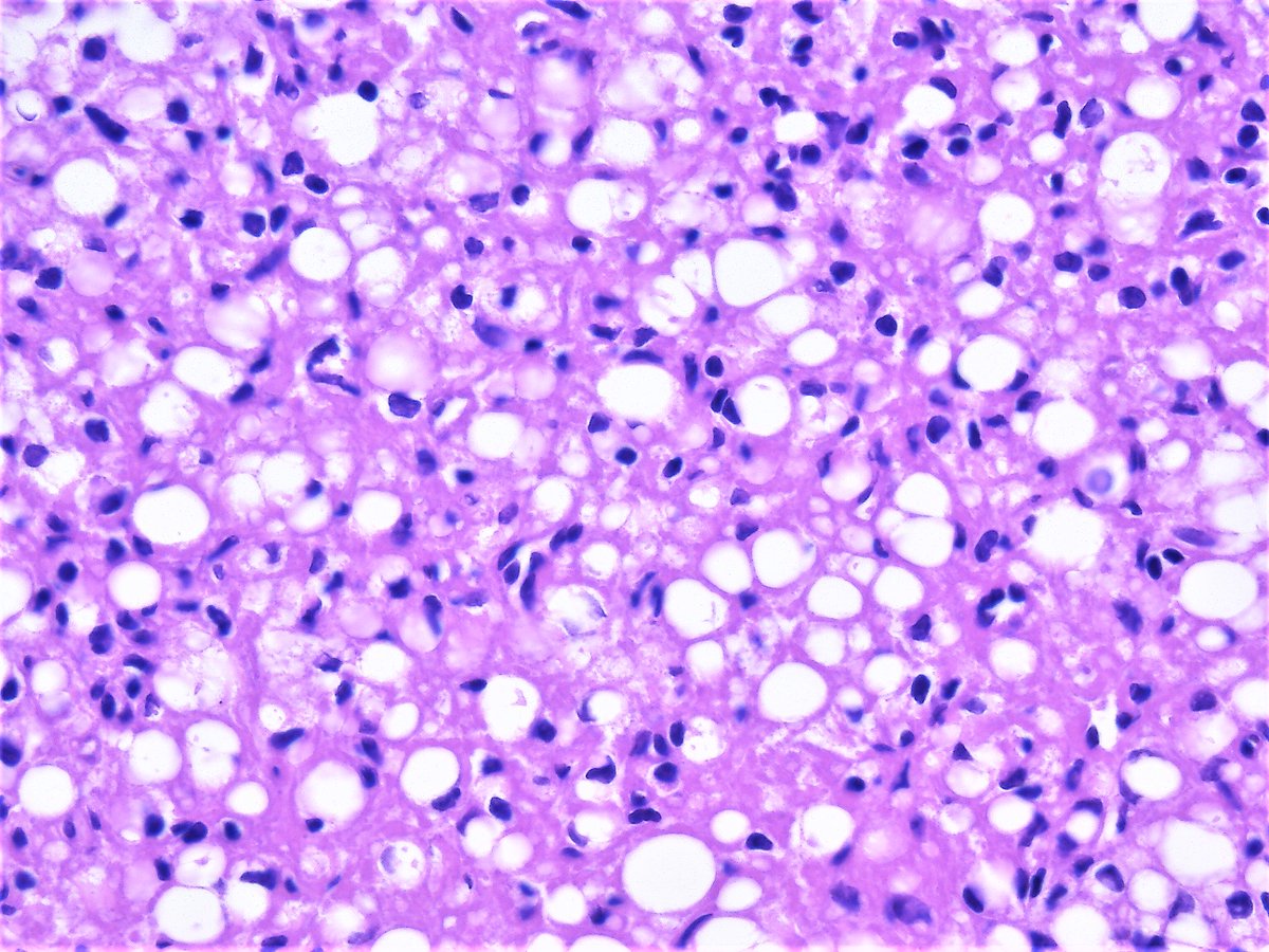 Signet-ring stromal tumor. Ovary, enucleation. HE stain.