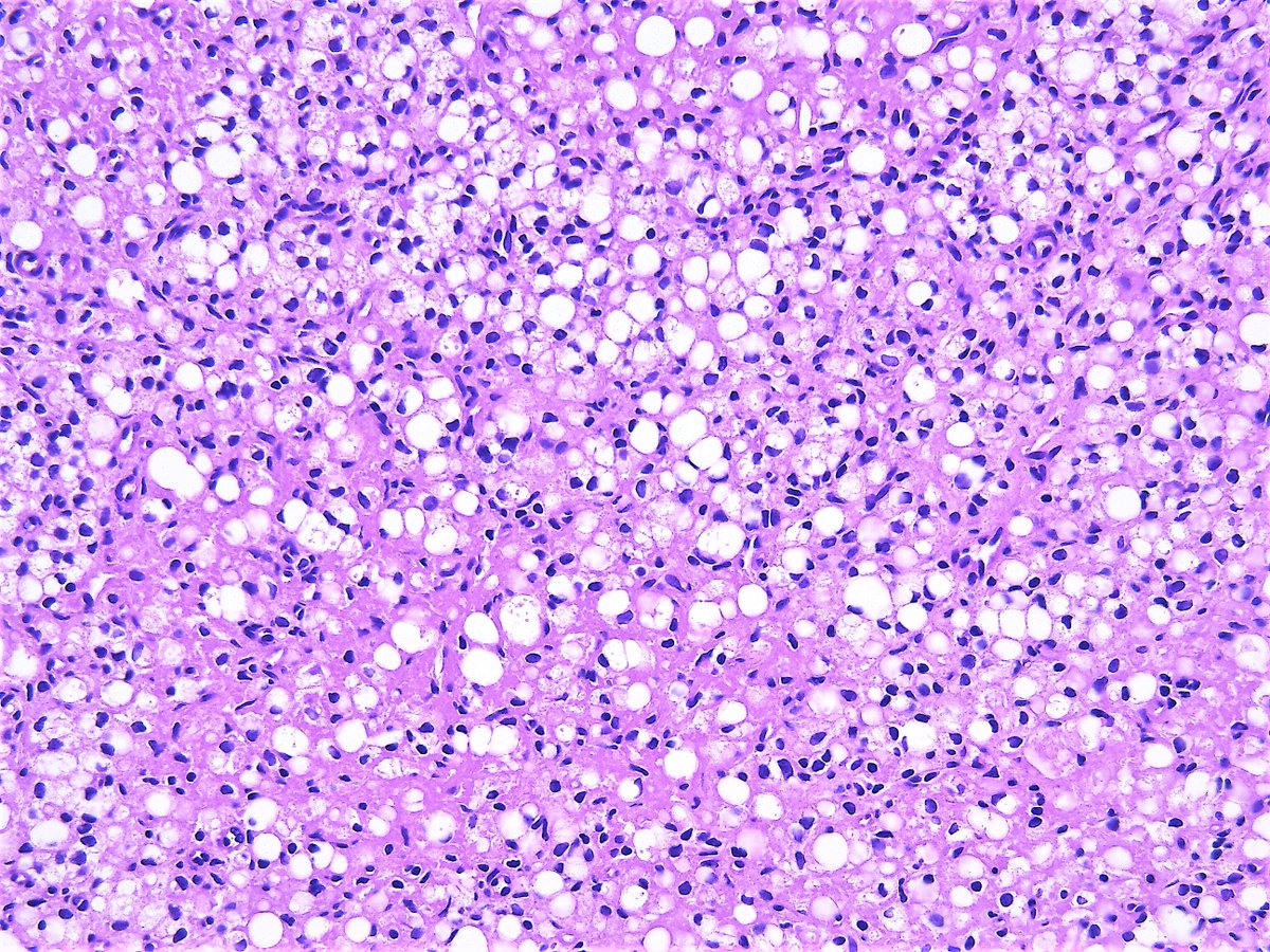 Patholwalker's tweet photo. Signet-ring stromal tumor. Ovary, enucleation. HE stain. https://t.co/O766UidnT1