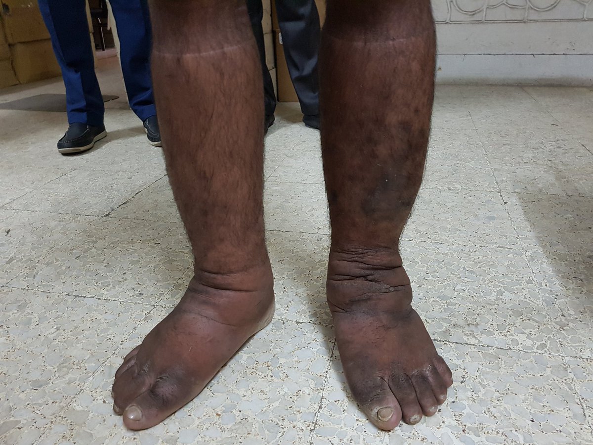 Jan_FRL's tweet photo. Can enhanced #selfcare improve outcomes for advanced stage #lymphoedema? In Bangladesh 20 000 people have lymphoedema. #LymphaticFilariasis program have enormous task to roll out #MorbidityManagement services to all. I hope our study will help those with the most severe disease https://t.co/bpdHyrA8gc