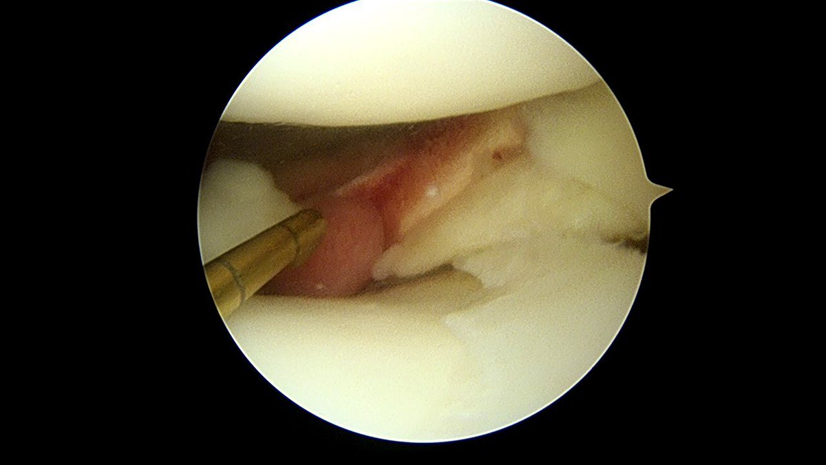 Sportscaduceus's tweet photo. Lateral meniscus tear 17 yo wrestler with acute ACL tear. Never seen this much men damage in young athlete with first injury @injurypics https://t.co/GrWuxyVcva