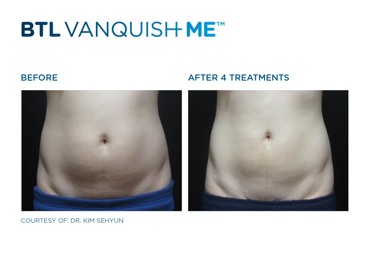 BTLaesthetics's tweet photo. Handle your love differently #BtlVanquishME for smoother & flatter abdomen. https://t.co/jwp0opav4A
#NoSurgery #NonInvasiveLipo #FatDissolve https://t.co/eXt0OLJNKZ