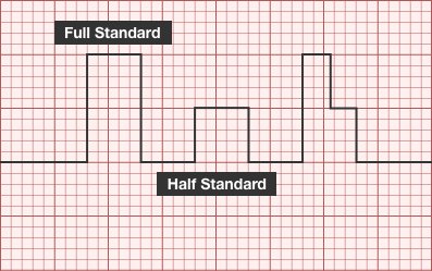 Quick review of pediatric ECG's with a focus on identifying age-related differences in ECG interpretation  #FOAMed ddxof.com/ecg-guide-pedi…