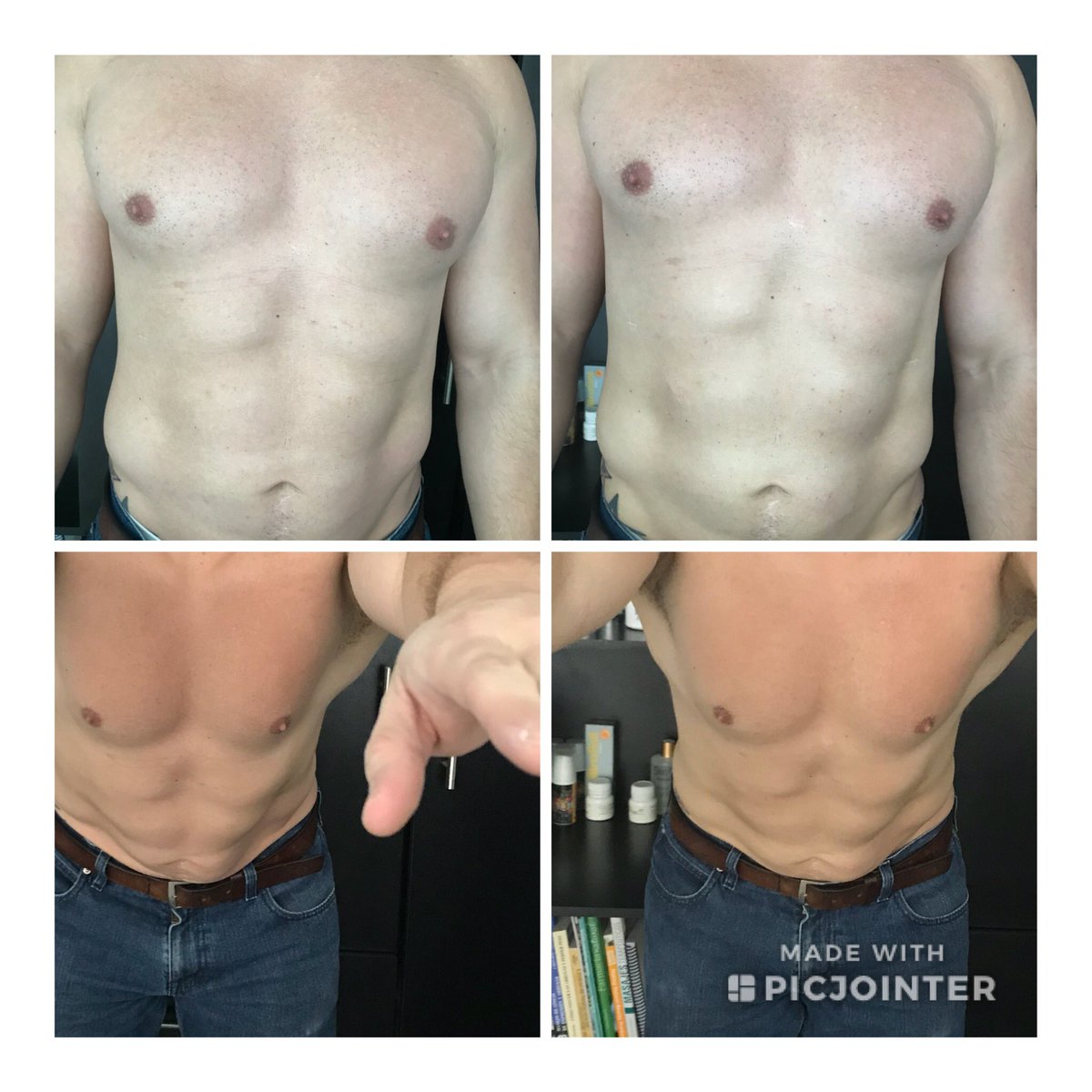 wellnesscenterg's tweet photo. Abdomen más definido para el verano. Cita gratis al 22783186 #endopeel no cirugía. https://t.co/n0wlizQ5aX