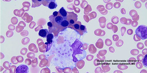 NCHforDocs's tweet image. This photomicrograph was taken from the bone marrow aspirate of a 12-year-old child who was found to have thrombocytopenia. What is the likely etiology? #NCHPath #PediPath #NCH_COTW