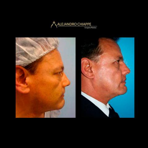 PMeditours's tweet photo. #Beforeandafter Blepharoplasty by Dr. Alejandro Chiappe https://t.co/FqaLfkMZ9X