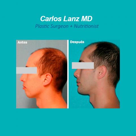 PMeditours's tweet photo. Before and after #Mentoplasty by Dr. Carlos Lanz https://t.co/asCyMWNF5j