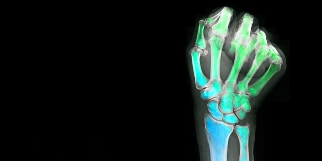 Draw a picture metallic Sloppy NVIDIA AI в Twitter: „Alexander Bilbily and @markcicero, radiologists and founders of 16 Bit, beat about 50 teams to win the @RSNA pediatric bone age competition using #GPU-accelerated #deeplearning: https://t.co/INo44AYu3y https://t.co/25H50fZzkn“ / Draw a picture metallic Sloppy NVIDIA AI в Twitter: „Alexander Bilbily and @markcicero, radiologists and founders of 16 Bit, beat about 50 teams to win the @RSNA pediatric bone age competition using #GPU-accelerated #deeplearning: https://t.co/INo44AYu3y https://t.co/25H50fZzkn“ /