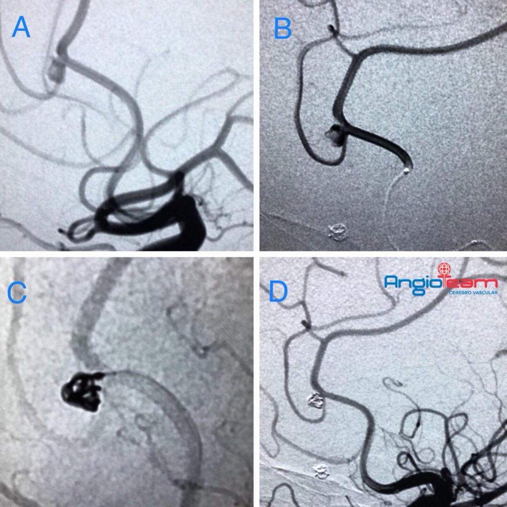 Angio_team's tweet photo. .
#AngioteamCase
55 years old woman, hypertensive and smoker. With multiple aneurysms, recent history of ruptured aneurysm in the right MCA treated with coils. Due to her antecedent, she requires left pericallosal aneurysm treatment. π https://t.co/rSDTzqxzjY https://t.co/ytxUuKyTyn