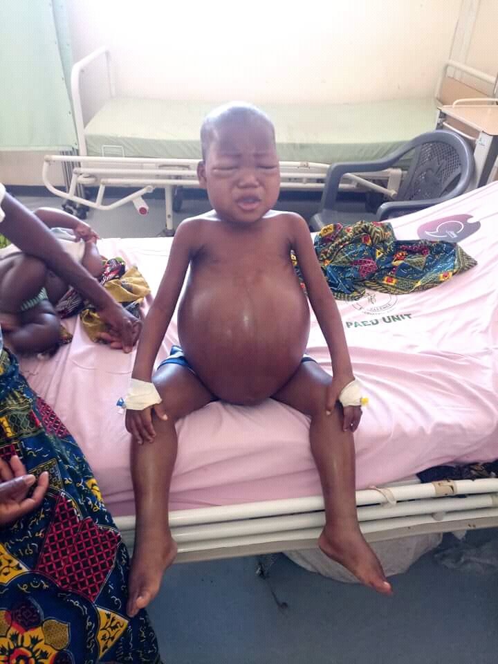wbabamu's tweet photo. A PLEA OF MERCY.
In this pic is Kojo a 4 year old boy n a native of Wulinsi in the Northern region. Kojo has been battling with intrinsic kidney failure which resulted in this magnitude of bloated stomach.The little boy need support #Lets save life @wunpini_fm @tv3_ghana @GHOneTV https://t.co/bKDJLuuB17