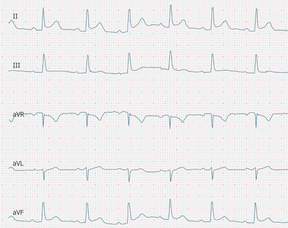 ecgbuddy's tweet photo. This 23 y/o male patient was admitted to the hospital three days ago. What are your thoughts on his illness? Hint: coronary artery disease was excluded by CT angiography at initial presentation. #ECG #ecgbuddy #studybuddy #ecginterpretation #ecgreading #ecgcourse #emergencyroom https://t.co/mQQaUjCmYJ