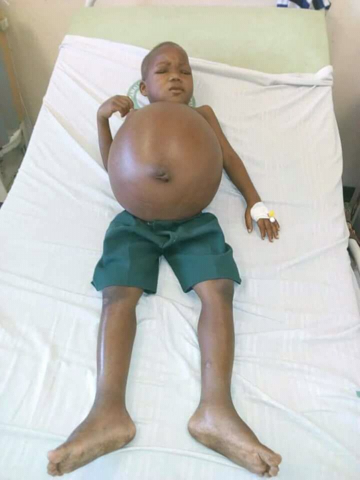 wunpini_fm's tweet photo. Kojo is a 4 year old boy from Wulensi who has been diagnosed with intrinsic kidney failure. This kidney abnormality, leads to the protruding of his stomach. 
Bank Account: Smile Life Foundation 2811408102503, UBA, Tamale.
https://t.co/41SchNtqGk
Mobile Money 0246458016
Please RT https://t.co/duJS5WW4Q7