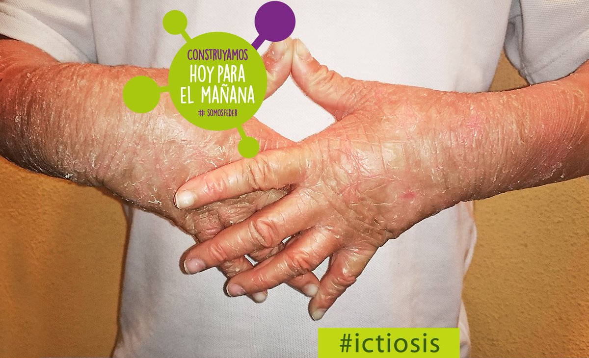 asociacionasic's tweet photo. Hoy, Día de las #EnfermedadesRaras, todos #somosFEDER porque "la #piel que nos diferencia es también la piel que nos une".

"Ponte en nuestra piel...", ponte en la piel de las #EnfermedadesRaras y construyamos hoy para el mañana. https://t.co/MHWrG0CUrr