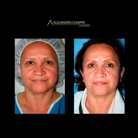PMeditours's tweet photo. Before and after #Blepharoplasty #PlasticSurgery https://t.co/l5ERptNAaT