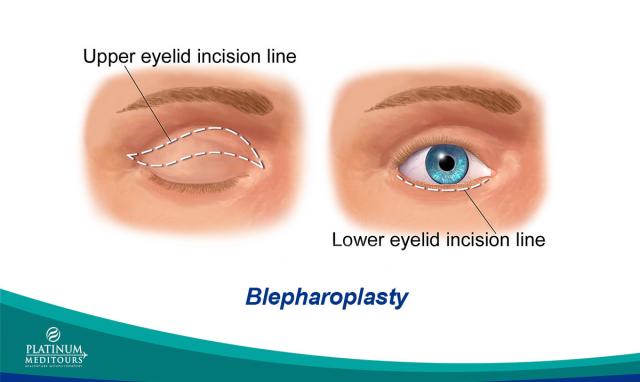 PMeditours's tweet photo. Removes or repositions excess fat #bags and the skin of the upper and lower eyelids, eliminating the onset of fatigue https://t.co/dmkGIXl0m6