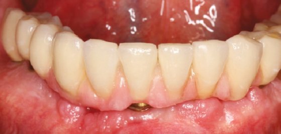 La #miseencharge #immediate : discussion autour par <a href="/FilDentaire/">FIL🇧🇷</a>  autour de ce cas complexe d' #implantologie  lefildentaire.com/articles/clini…