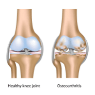 FootandLegClin's tweet photo. For arthritis treatment, the use of orthotics is extremely effective for knee and foot pain. Find out more - https://t.co/HkLJO9OA26 https://t.co/eu4n0yDkv2