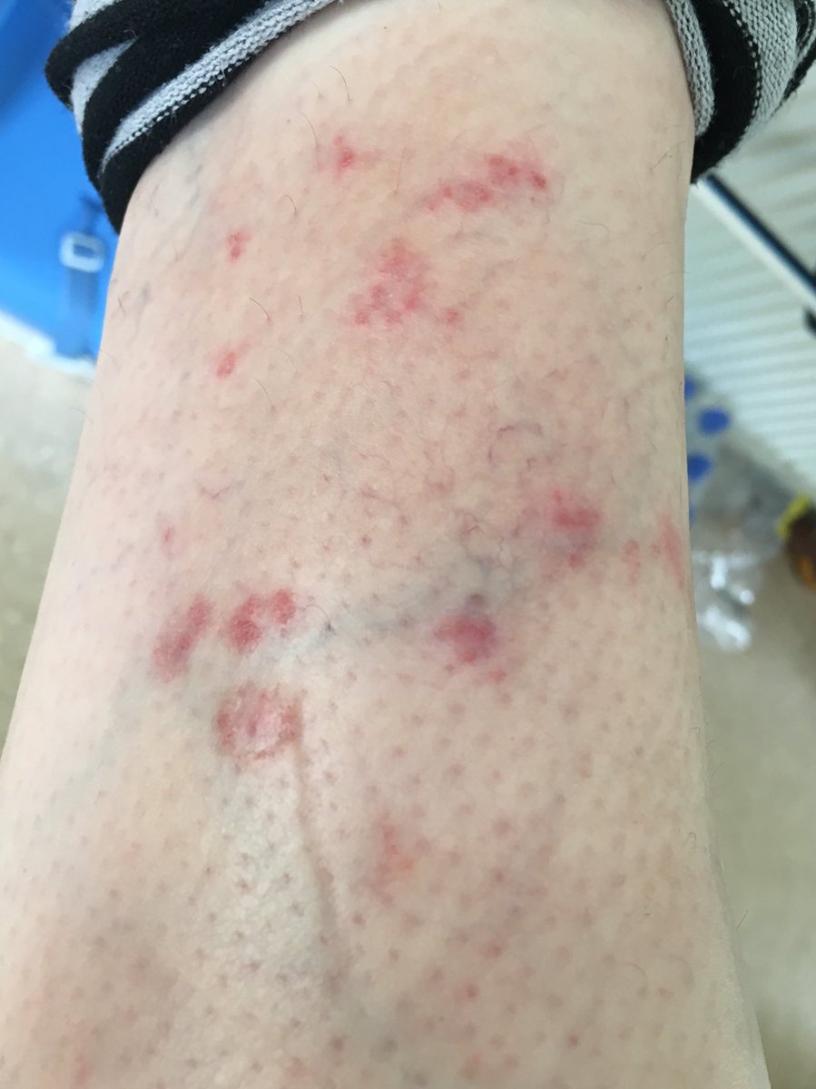 KristyPMLew15's tweet photo. @PhilipsBlueLED I seriously can’t believe the difference 2 weeks has made! My psoriasis is breaking up and my skin is so much smoother. I’m feeling a lot more confident now I know I can manage it myself! Thanks! https://t.co/diXuNOKu0e