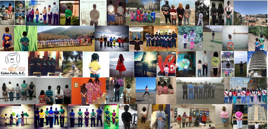 DrsPenaBischoff's tweet photo. Today is the day that we honor all of those born with Congenital Colorectal Conditions (Imperforate Anus, Cloaca, Cloacal Exstrophy, Hirschsprung, TCA). #rarediseaseday research #ShowYourRare @rarediseaseday #colorectalsurgery #pedsurg https://t.co/s0QvKQ87Ig