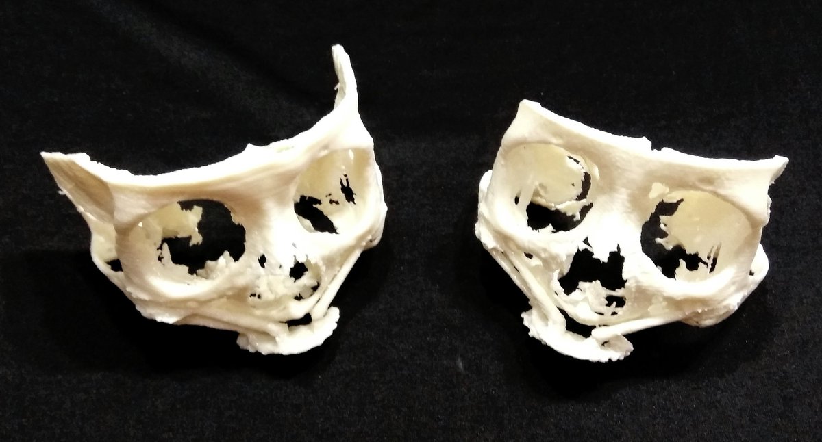 MM3D_'s tweet photo. #impresión3d de #cráneo parte frontal. #zigomatico #3DPrinting #3dmodel #bones #medicalmodel3d #medicaldevice #traumatologia #maxilofacial #maxilofacialsurgery #surgeryplanning https://t.co/kr1EYWQ3mR