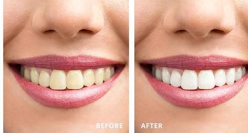 mrblackteeh's tweet photo. Hey!! Do you want to know how she get her teeth white like this in a few minutes
"Guess" ..
Its #mrblackteeth
Order it now from our link is in bio
#smile #teeth #happy #teethwhiten #teethwhitening #teethwhitener #teethwhiteningkit #teethwhiteningproduct #mrblackteeth #happysmile https://t.co/lv8NawPXi0