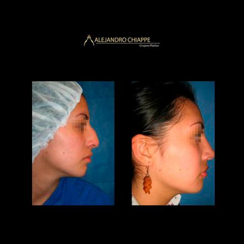 PMeditours's tweet photo. Rhinoplasty Results #PlasticSurgery https://t.co/JSDgaKBd1p