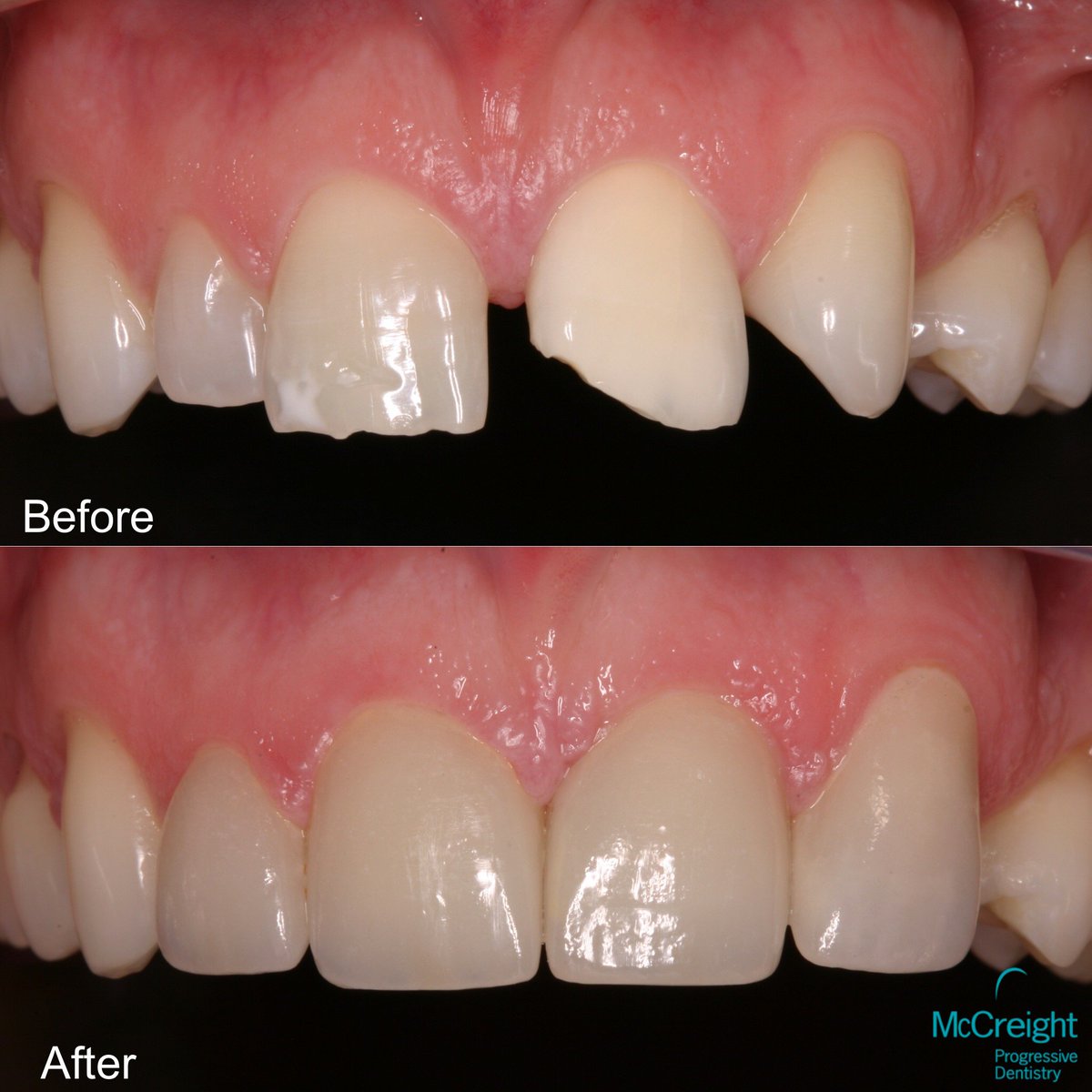 MPDWay's tweet photo. Most dentists would not do a 4 unit case instead making it a 6, 8 or 10 unit case however finances were a concern for this client. The very talented @steamboatsmiles Dr. McCreight along with our fabulous ceramist @UlfBroda at @aurumgroup made this case come to life! #MPDWay https://t.co/M89BokfnxV
