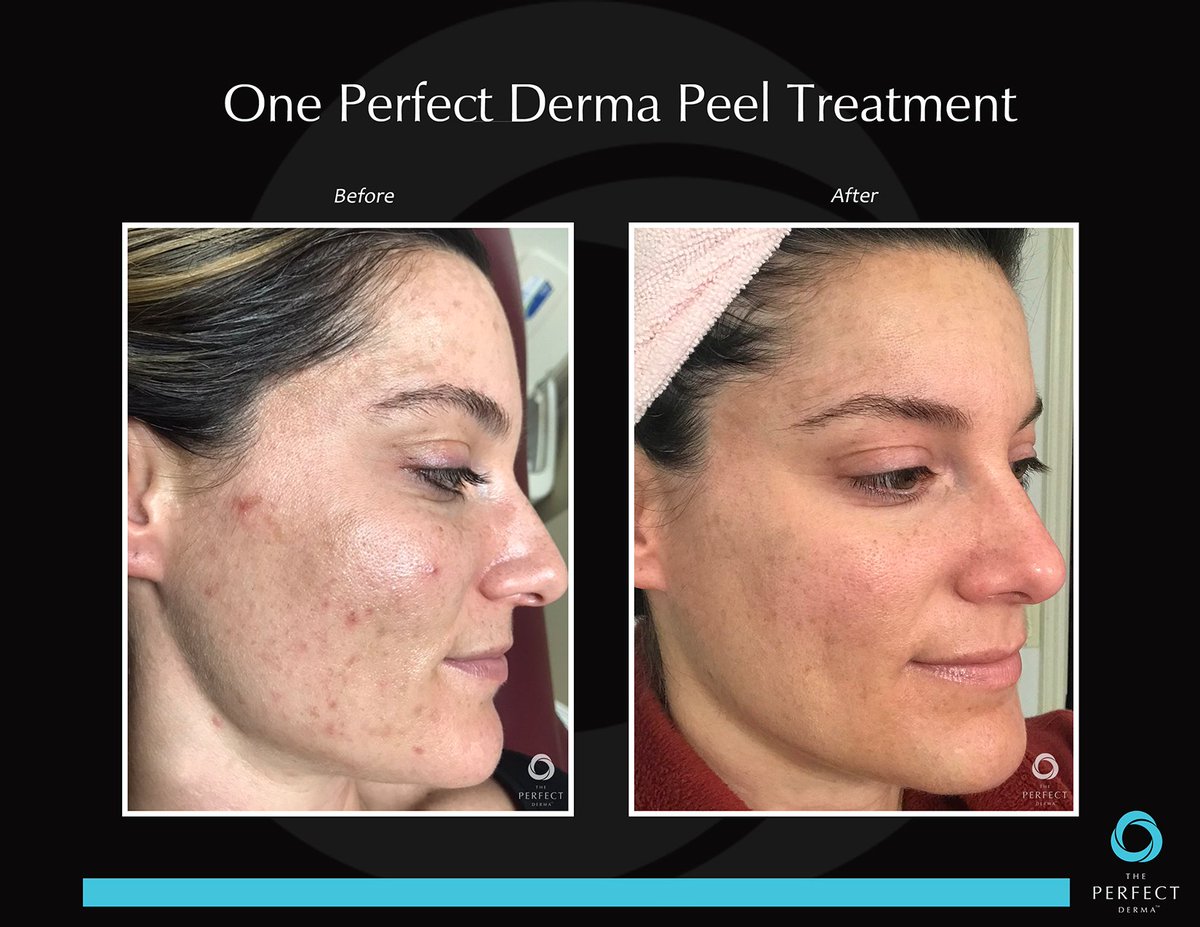 ThePerfectDerma's tweet image. 1 Perfect Derma Peel treatment! 

For optimal longterm results for pigmentation issues, ask your doctor or medical esthetician about adding The Perfect Bleaching Cream to your home care regimen.