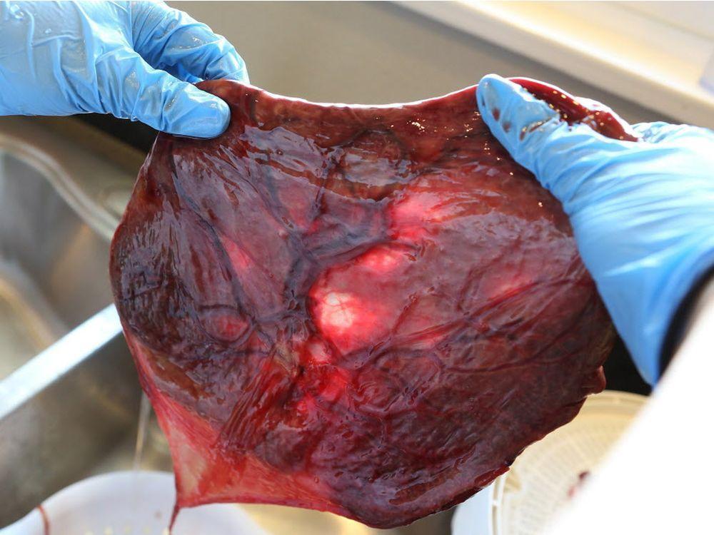 VancouverSun's tweet photo. Placenta eating and vaginal seeding addressed at Vancouver conference https://t.co/NHs4J61PLI https://t.co/OjYVKLIz2x