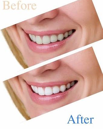 mrblackteeh's tweet photo. "A smile can gain 10 years more in your life" if you can't smile just because of your yellowish teeth๐ค
No worries๐ just use #mrblackteeth and make your teeth white in just 10 mins order it now link is in bio
#smile #teeth #happy #teethwhiten #teethwhitening #teethwhitener https://t.co/U46F6Z5PiZ