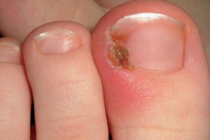 FootandLegClin's tweet photo. Top tip to avoid ingrown toenails! Wear shoes that fit the shape of your foot. For more tips click here -
https://t.co/6X1DvlDrbb https://t.co/i5be6O7y2v