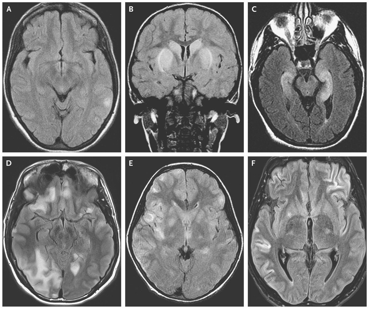 Review Article: Antibody-Mediated Encephalitis nej.md/2F2q1vO