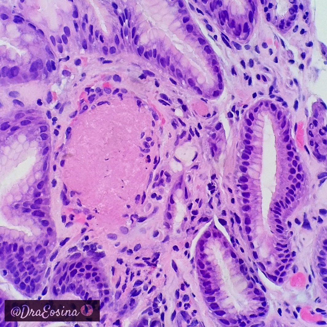 Khanh Ho On Twitter Gastric Antral Vascular Ectasia Gave Watermelon Stomach On Endoscopy Histology Increase In Blood Vessel Number And Diameter With Fibrin Thrombi Reactive Foveolar Epithelial Changes Gipath Pathology