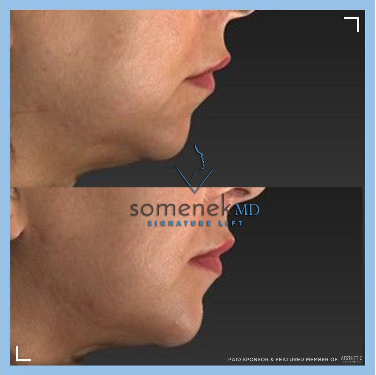 .<a href="/SomenekMD/">Dr. Michael Somenek</a>: "A before and after on her chin. I used my signature lift here to help improve the condition. If you'd like to see and learn more about the Somenek Signature Lift, then come attend our Facetite Event on March 7th @ 5PM!"

(202) 810-7700  somenekmd.com