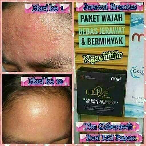 Sahabat tweter siapa tau ada wajahnya yg lagi bermasalah dgn jerawat yuk di order produk dri MSI..
Ngewar sambil promo
#FildanAdaDiLIDAMaluku