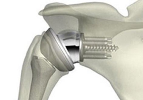 RandyClarkMD's tweet photo. Debridement cited as better initial option to treat infection after reverse shoulder arthroplasty https://t.co/0fevNZVzOc https://t.co/6rcqXZftpB