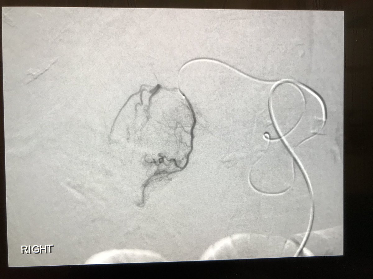 ClintWrigley's tweet photo. Ruptured HCC with occluded celiac no match for #IRad , Direxion HI-FLO , Embospheres and a little patience. @MeritMedical @bostonsci https://t.co/dR3Y7NjuiL