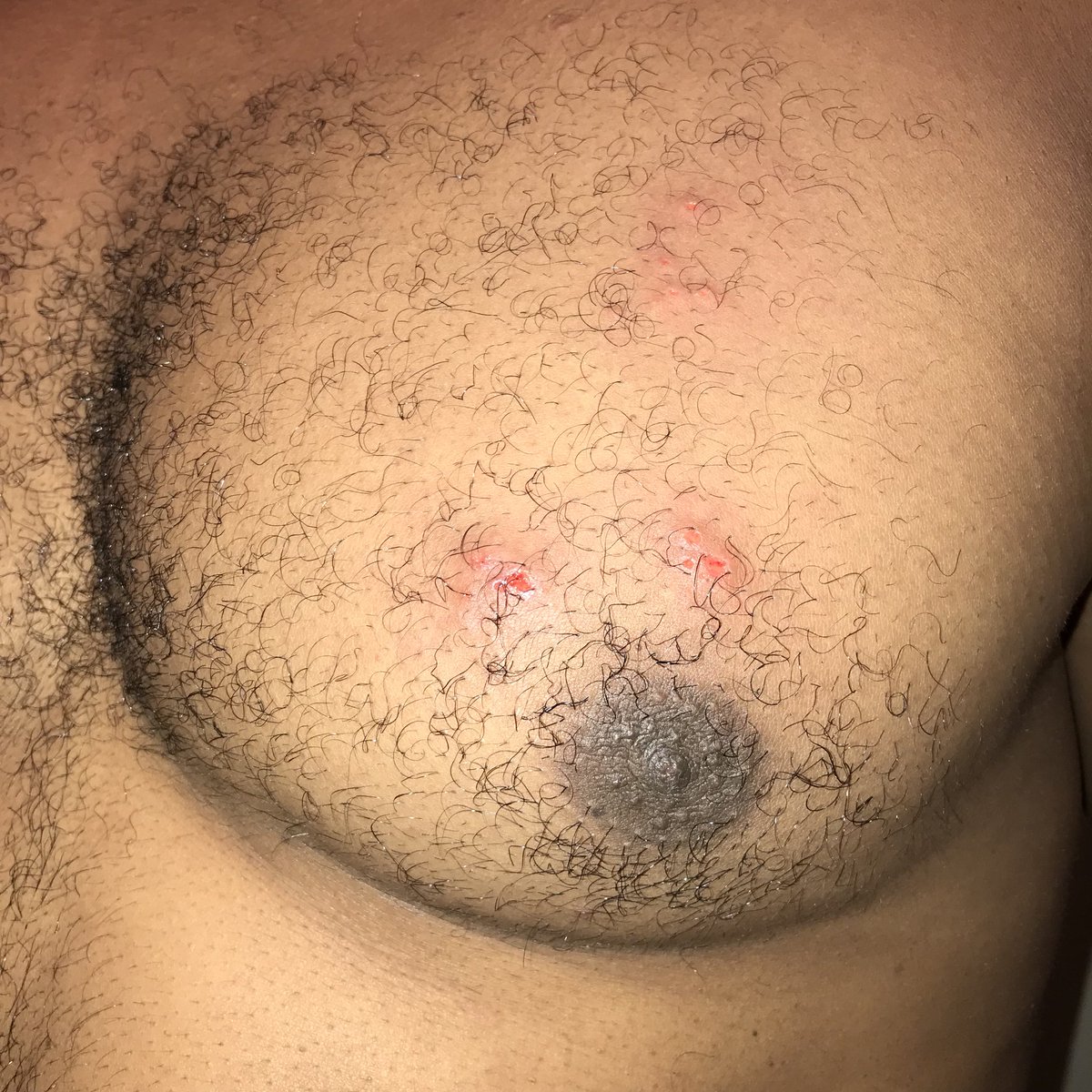 reneeCabactnoh's tweet photo. Day2.. Don’t leave your iPhone in your shirt pocket for too long if you’re playing music ladies and gentlemen. They get hot and will blister your skin up bad. And it doesn’t feel good at all https://t.co/Oz6tvjtJsB