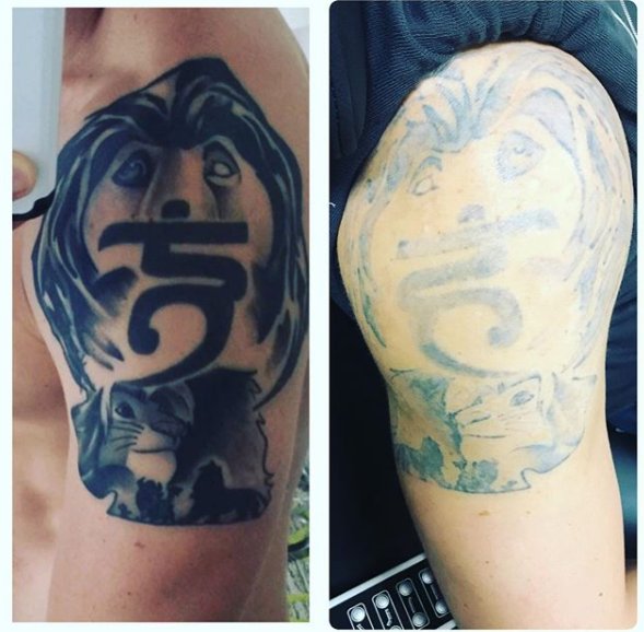 martasmedispaMD's tweet photo. Interested in removing a tattoo that doesn't hold meaning to you anymore? With PicoSure's advanced laser technology, your tattoo no longer has to be permanent. Call (818) 476-5107 to learn more! https://t.co/XeEQbgBGql