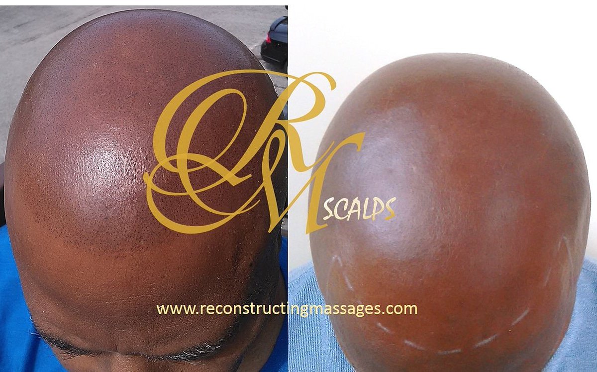 Book your Scalp Micropigmentation appointment today! Call 813-385-1361 visit ReconstructingMassages.com for more info
#smp #scalpmicropigmentation #hairline #tattoo #hairtattoo #scalptattoo #tampabarber #tampahair #tampalashes #microbladingtampa #tampabay #seminoleheights #florida