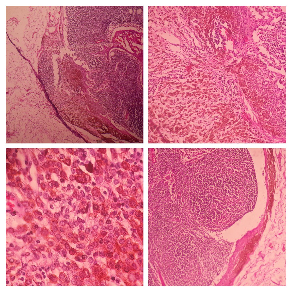 Nevus cells in a lymph node.