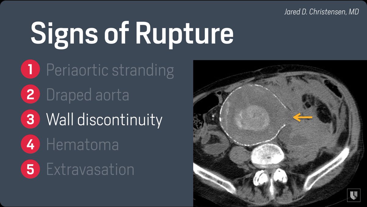 JRadMD's tweet image. Following #STR2018, excited for a great crowd at the @DukeRadiology #DukeReview Course next week where I will be speaking on aortic disease. Case preview: