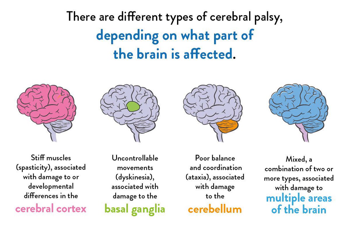 vchows_triad's tweet photo. Movement analysis can provide clues for identifying the type of cerebral palsy your patient has:
Spastic—inc tone &amp; spasticity, impaired selective control
Dyskinetic—involuntary movement patterns
Ataxia—wide BOS &amp; general instability
#PT546week9 @juliehershberg @bsargent_usc https://t.co/UWjiDCdcy3