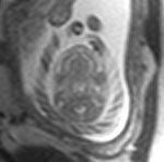 jcollinsmd77's tweet photo. OB Facts : UCA is a significant cause of stillbirth. Most stillbirth studies do not include all Umbilical Cord Pathologies including Torsion. https://t.co/PbhC1rGpkO