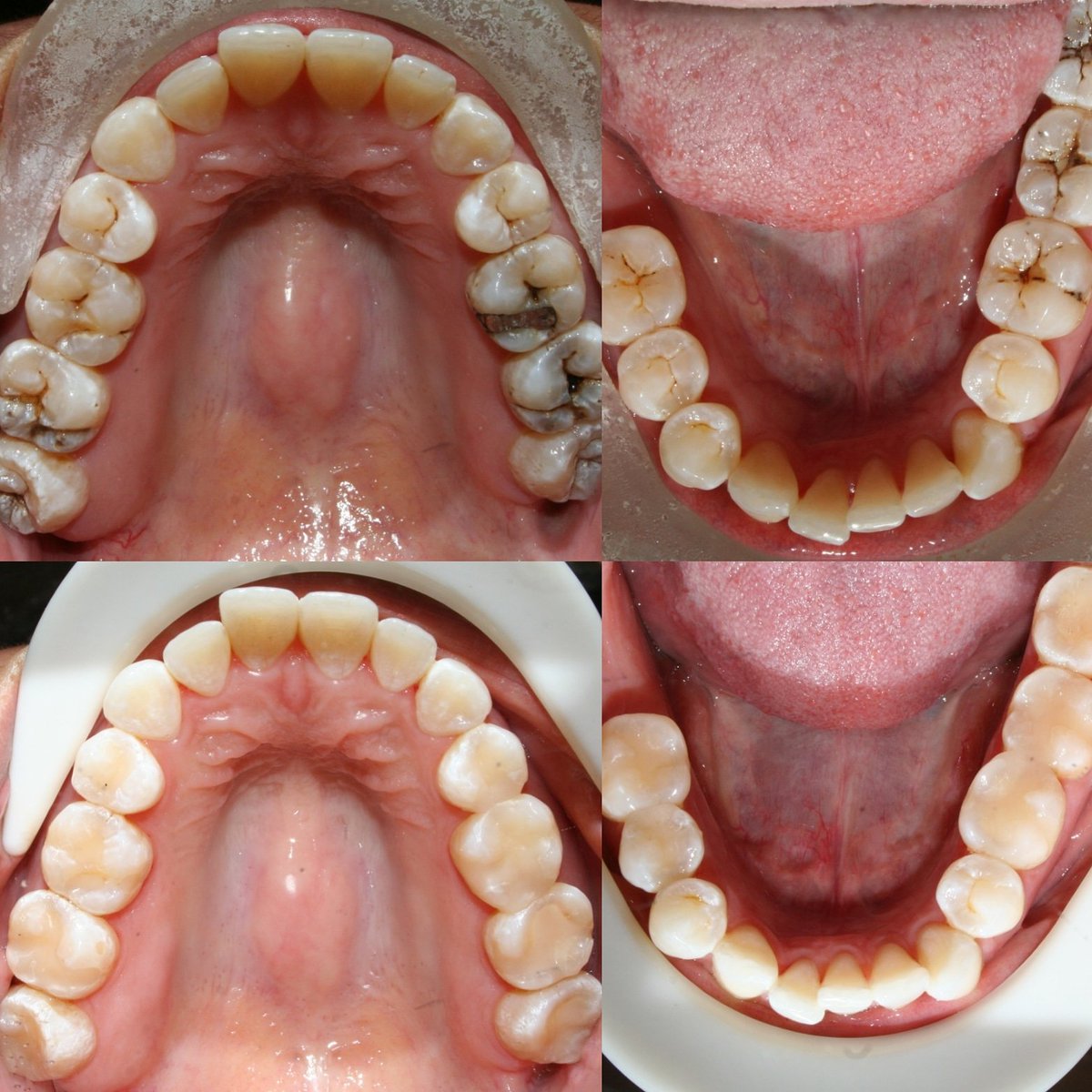 sandrareyesdds's tweet photo. 3 year post-op of resin restorations.
#dentist #dentistry #dental #amalgam #resin #composite #cosmeticdentistry #silverfillings #whitefillings #aestheticdentistry https://t.co/FlNc1nEsNi