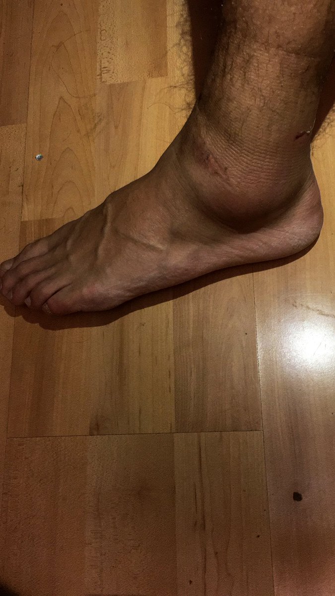 Y asi mi tobillo hoy 😷