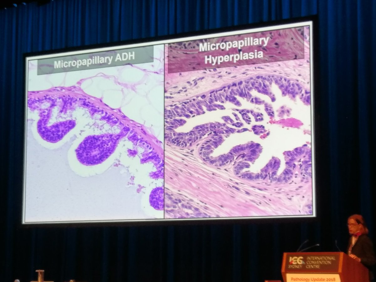 drkennethtang's tweet image. Micropapillary hyperplasia has tapering ends. Micropapillary ADH has bulbous ends. #breastpath #PathUpdate