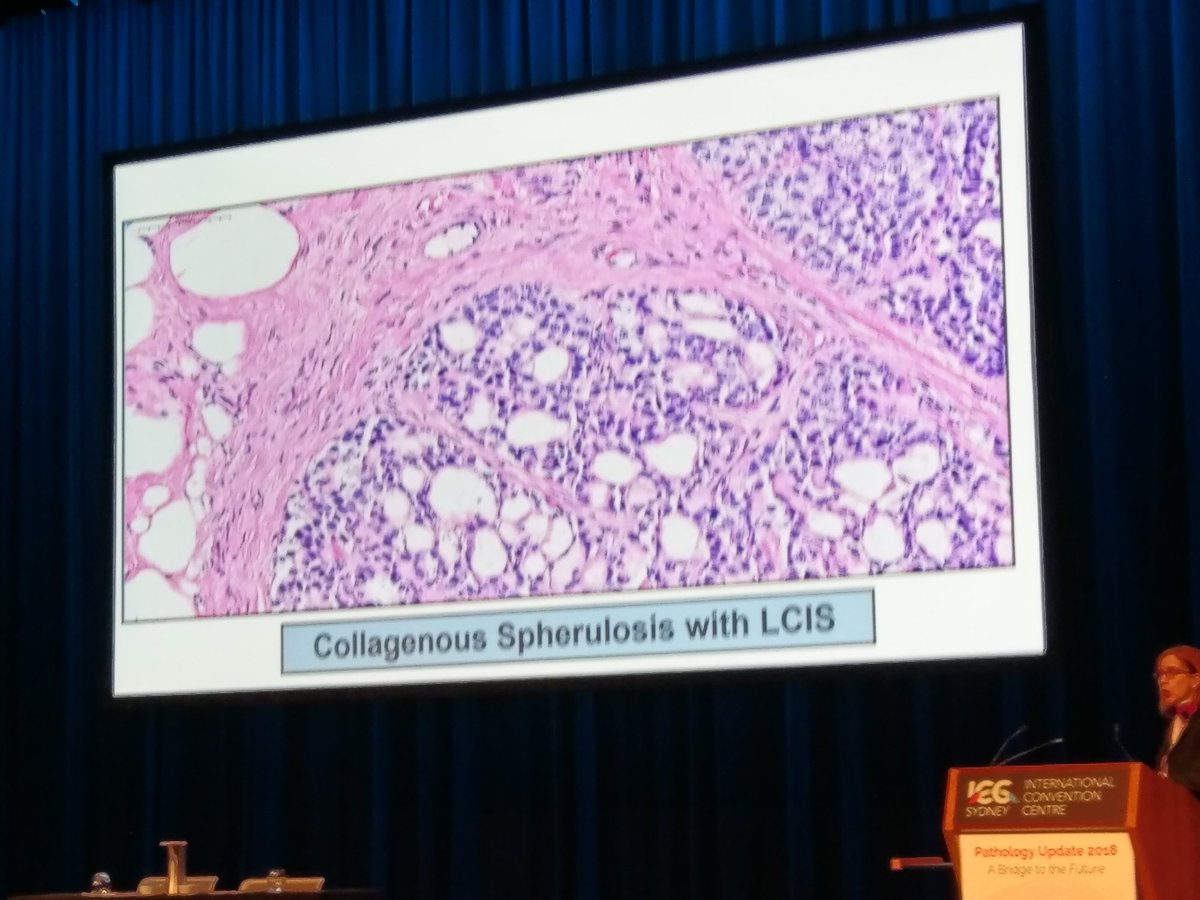 drkennethtang's tweet image. This mimicks DCIS. #breastpath #PathUpdate